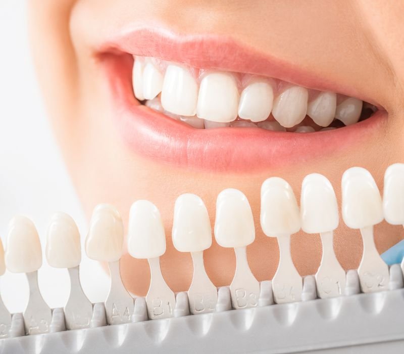 Carillas Dentales Y Diseño De Sonrisa